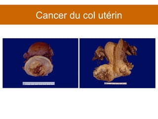 Cancer du col utérin 