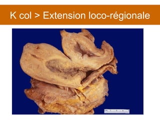 K col > Extension loco-régionale 