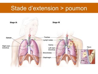 Stade d’extension > poumon 