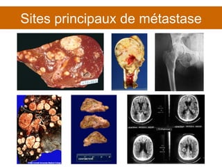 Sites principaux de métastase 