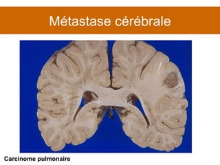 Métastase cérébrale Carcinome pulmonaire 