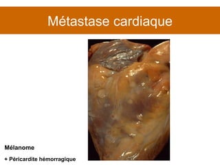 Métastase cardiaque + Péricardite hémorragique Mélanome 