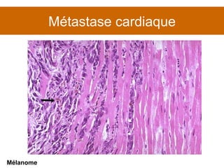 Métastase cardiaque Mélanome 