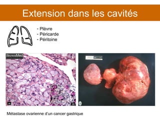 Extension dans les cavités Métastase ovarienne d’un cancer gastrique Plèvre Péricarde Péritoine 