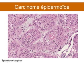 Carcinome épidermoïde Épithélium malpighien 