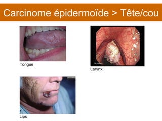 Carcinome épidermoïde > Tête/cou Larynx Tongue Lips 