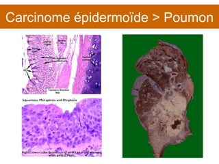 Carcinome épidermoïde > Poumon 