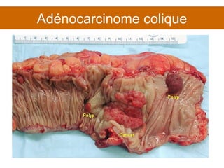 Adénocarcinome colique 