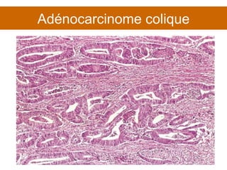 Adénocarcinome colique 