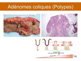 Adénomes coliques (Polypes) 