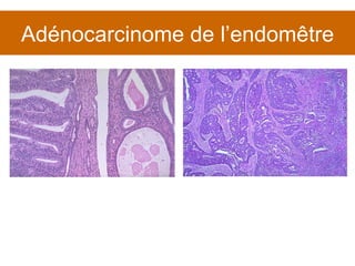 Adénocarcinome de l’endomêtre 