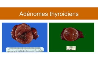 Adénomes thyroidiens 
