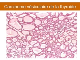 Carcinome vésiculaire de la thyroide 