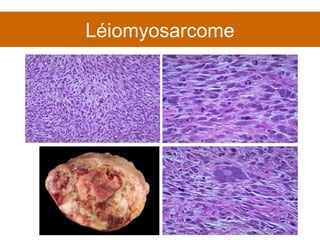 Léiomyosarcome 
