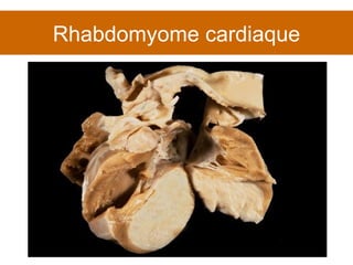 Rhabdomyome cardiaque 
