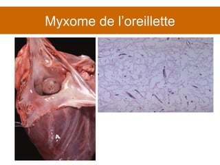 Myxome de l’oreillette 