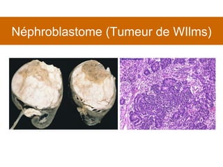 Néphroblastome (Tumeur de WIlms) 