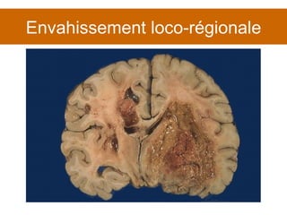 Envahissement loco-régionale 
