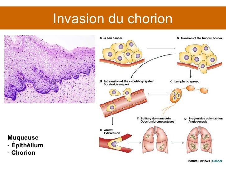 Inflammation Du Chorion – Chorioamniotite Traitements – UUZN