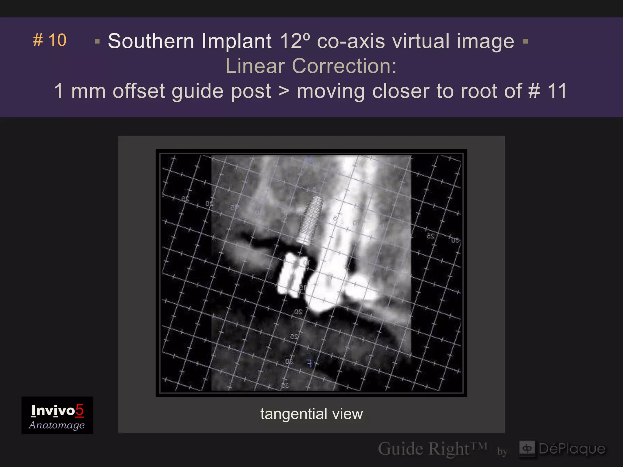 Invivo5
# 10  ▪ Southern Implant 12º co-axis virtual image ▪
                           Anatomage
                    Linear Correction:
   1 mm offset guide post > moving closer to root of # 11




Invivo5                 tangential view
Anatomage
 