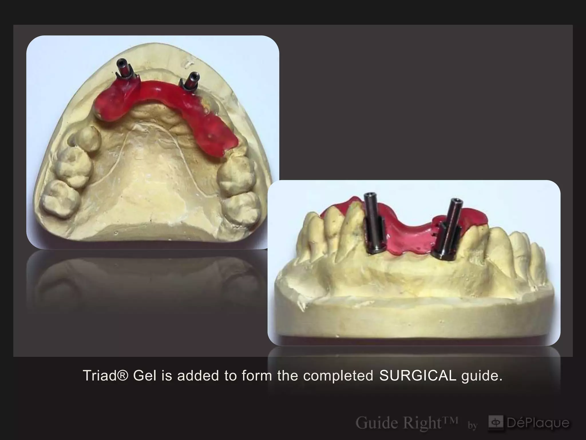 Triad® Gel is added to form the completed SURGICAL guide.
 