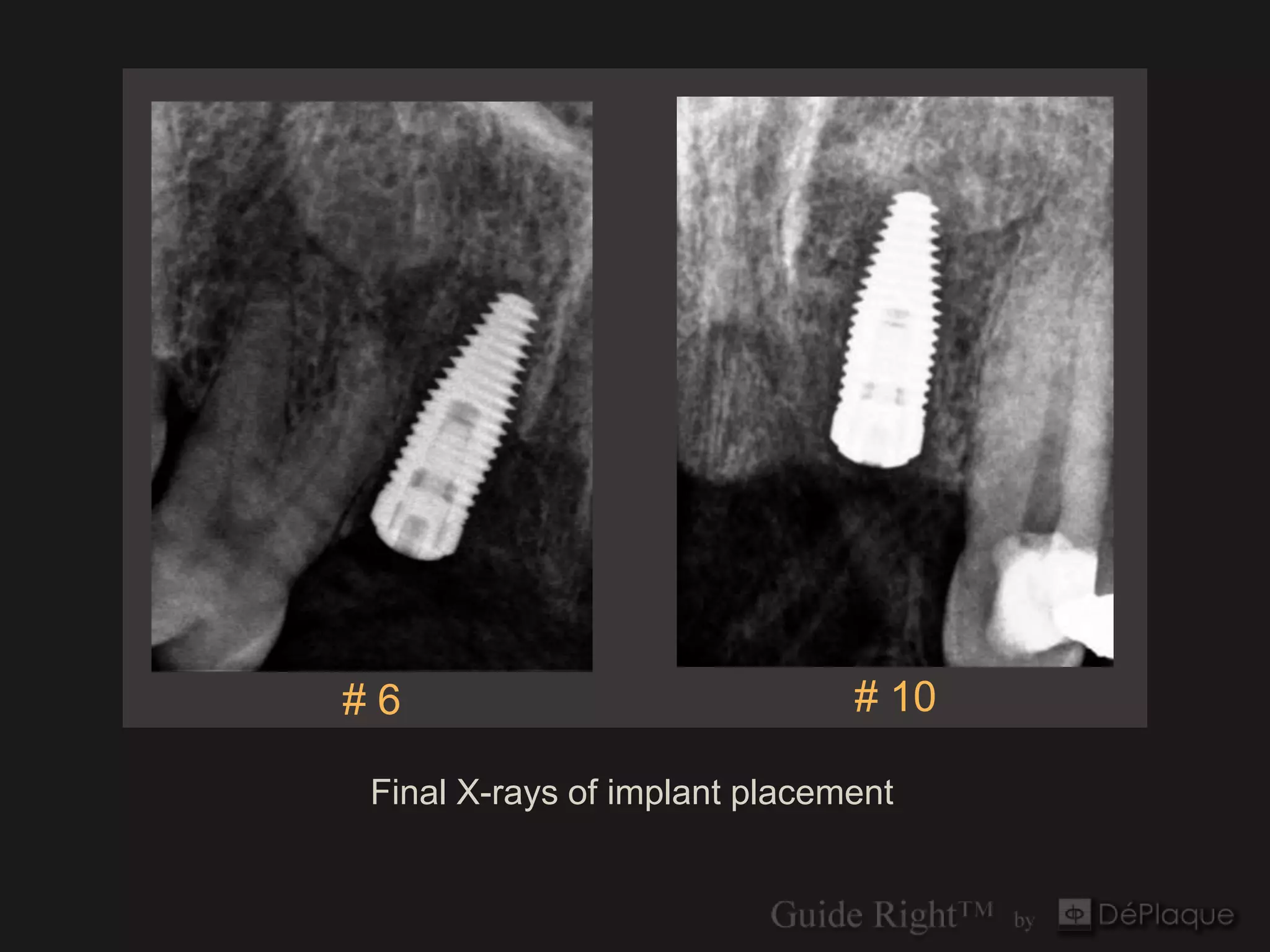 #6                            # 10

Final X-rays of implant placement
 