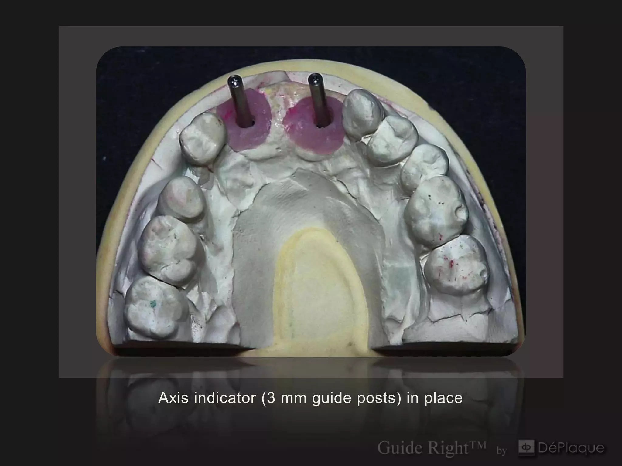 Axis indicator (3 mm guide posts) in place
 