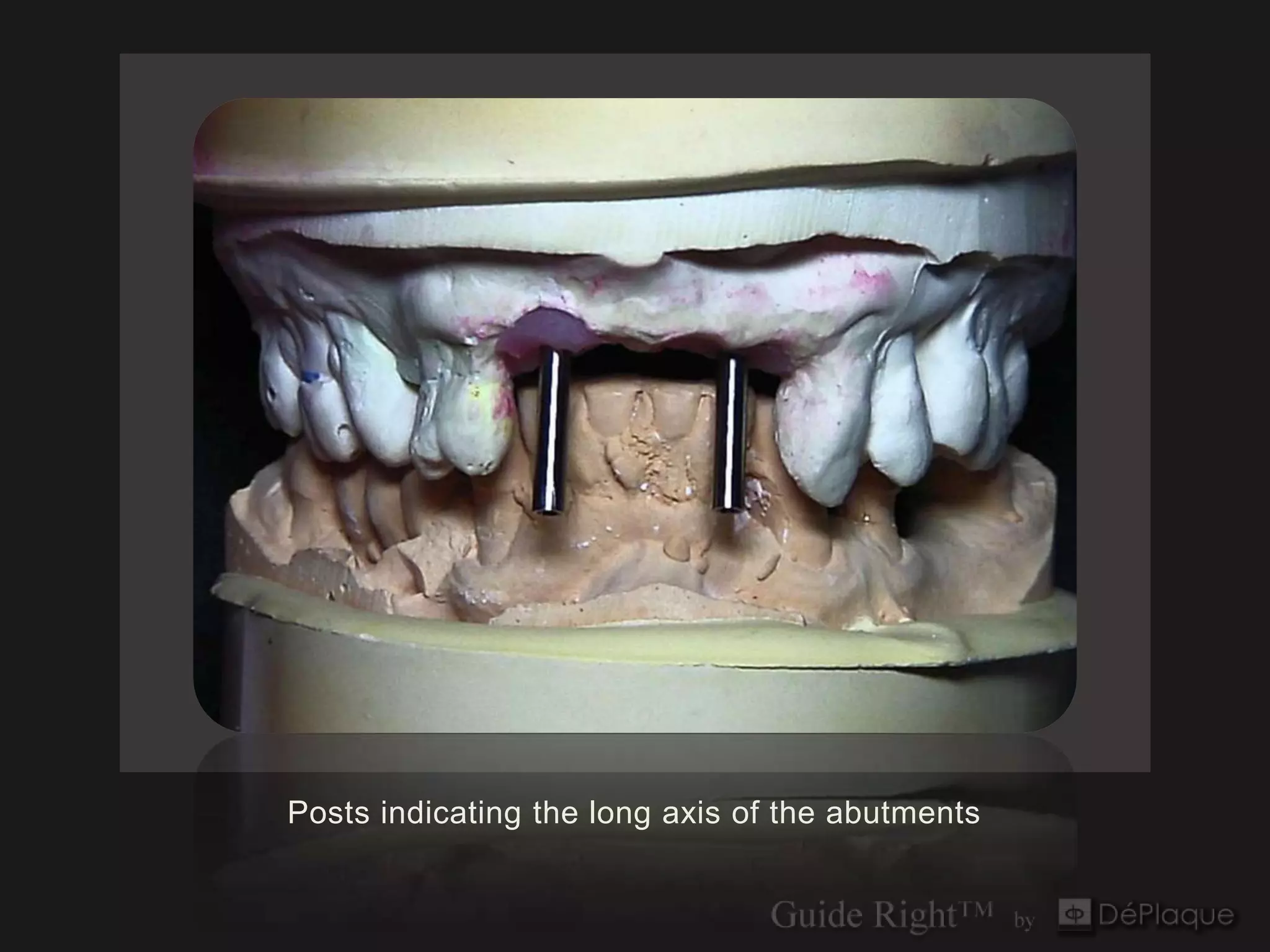 Posts indicating the long axis of the abutments
 