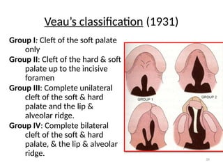 Veau Classfication 11 CLEFT LIP AND PALATE.pptx orthodontics | PPTX