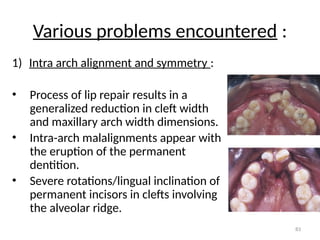 11 CLEFT LIP AND PALATE.pptx orthodontics | PPTX