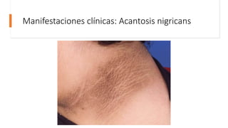 Manifestaciones clínicas: Acantosis nigricans
 