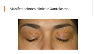 Manifestaciones clínicas: Xantelasmas
 