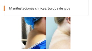 Manifestaciones clínicas: Joroba de giba
 