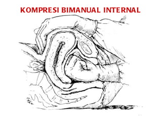 KOMPRESI BIMANUAL INTERNAL 
