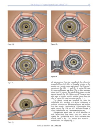 ula was removed from the tunnel and the nylon wire
was pulled from both sides of the radial incision to dis-
sect deep to corneal stroma leaving only the Descemet’s
membrane (fig. 1G, 1H and 1I). A partial-thickness
8.0 mm trephination was done. The trephine was used
to cut until it touches the spatula beneath the corneal
stromal tunnel (fig. 1J). Blunt-tipped Vannas scissors
were used to remove anterior stromal tissue along the
edge of partial thickness trephination (fig. 1L).
The donor cornea was punched out from the
endothelial side, oversized by 0.5 mm, comparing to
recipient trephination. The donor button was sutured
into place using a continuous or 16 interrupted 10-0
nylon sutures (fig. 1M and 1N), without removal of
donor endothelium and Descemet’s membrane.
Postoperative medication included Moxifloxacin
and Prednisolone four times a day for a week and
tapered for a period of 6 weeks. Lubricants were used
several times a day. The sutures were removed 3
months after the surgery (fig. 2).
NEW TECHNIQUE OF DEEP ANTERIOR LAMELLAR KERATOPLASTY 81
JOURNAL OF EMMETROPIA - VOL 2, APRIL-JUNE
Figure 1G. Figure 1H.
Figure 1L.
Figure 1I.
Figure 1J.
 