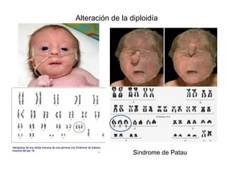 Sindrome de Patau
Alteración de la diploidía
 