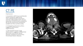 CT PE
Impression:
1. Eccentric soft tissue and bands
within bilateral segmental
and subsegmental pulmonary
arteries compatible with chronic
sequelae of pulmonary embolism.
No acute pulmonary embolism
evident on the current study.
2. Enlarged pulmonary artery
suggests pulmonary
hypertension.
3. Decreased mosaic lung
attenuation suggests differential
perfusion and small vessel
disease related to pulmonary
thromboembolic disease.
 