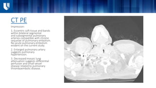 CT PE
Impression:
1. Eccentric soft tissue and bands
within bilateral segmental
and subsegmental pulmonary
arteries compatible with chronic
sequelae of pulmonary embolism.
No acute pulmonary embolism
evident on the current study.
2. Enlarged pulmonary artery
suggests pulmonary
hypertension.
3. Decreased mosaic lung
attenuation suggests differential
perfusion and small vessel
disease related to pulmonary
thromboembolic disease.
 