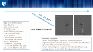 Right Heart Catheterization
State: Baseline
RA: 9 mmHg (mean)
RV: 77/ 7 mmHg
PA: 81/ 34 49 mmHg (mean)
PCW: 11 mmHg (mean)
AV O2: 4.7 vol%
Cardiac output: 6.9 L/min
Cardiac index: 2.8 L/min-m2
PVR: 5.5 Wood units
Shunt Ratio: 1.0 (Qp/Qs)
L to R shunt: 0.0 L/min (Qp-Qep)
R to L shunt: 0.0 L/min (Qs-Qep)
+ IVC Filter Placement
Pulmonary Angiogram:
There is relative oligemia in portions of the mid and lower
lung including near complete absence of flow within the RML lateral
segment and RLL anterior basal segment.
There is relative oligemia portions of the left mid and lower lung
including absence of flow within the lingular segments.
 