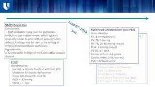 Right Heart Catheterization (7/13/2017,
pre-PEA)
State: Baseline
RA: 9 mmHg (mean)
RV: 77/ 7 mmHg
PA: 81/ 34 49 mmHg (mean)
PCW: 11 mmHg (mean)
AV O2: 4.7 vol%
Cardiac output: 6.9 L/min
Cardiac index: 2.8 L/min-m2
PVR: 5.5 Wood units
Shunt Ratio: 1.0 (Qp/Qs)
L to R shunt: 0.0 L/min (Qp-Qep)
R to L shunt: 0.0 L/min (Qs-Qep)
Right Heart Catheterization (post-PEA)
State: Baseline
RA: 1 mmHg (mean)
RV: 71/ 1 mmHg
PA: 71/ 26 40 mmHg (mean)
PCW: 6 mmHg (mean)
AV O2: 5.5 vol%
Cardiac output: 6.1 L/min
Cardiac index: 2.4 L/min-m2
PVR: 5.6 Wood units
NM Perfusion Scan
Conclusions:
1. High probability lung scan for pulmonary
embolism, age indeterminate, which appears
relatively similar to prior with no new perfusion
defects. Findings may be seen in the setting of
chronic thromboembolic pulmonary
hypertension.
2. Scintigraphic findings of mild obstructive airways
disease.
ECHO
Interpretation:
Normal LV systolic function with mild LVH
Moderate RV systolic dysfunction
Trivial MR, trivial PR, mild TR
RVSP = 87mmHg
TAPSE = 1.7cm
 