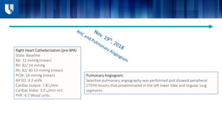 Right Heart Catheterization (pre-BPA)
State: Baseline
RA: 12 mmHg (mean)
RV: 82/ 14 mmHg
PA: 82/ 40 53 mmHg (mean)
PCW: 16 mmHg (mean)
AV O2: 4.3 vol%
Cardiac output: 7.8 L/min
Cardiac index: 3.0 L/min-m2
PVR: 4.7 Wood units
Pulmonary Angiogram:
Selective pulmonary angiography was performed and showed peripheral
CTEPH lesions that predominated in the left lower lobe and lingular lung
segments.
 