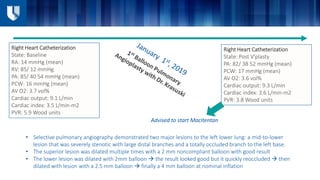 Right Heart Catheterization
State: Baseline
RA: 14 mmHg (mean)
RV: 85/ 12 mmHg
PA: 85/ 40 54 mmHg (mean)
PCW: 16 mmHg (mean)
AV O2: 3.7 vol%
Cardiac output: 9.1 L/min
Cardiac index: 3.5 L/min-m2
PVR: 5.9 Wood units
Right Heart Catheterization
State: Post V'plasty
PA: 82/ 38 52 mmHg (mean)
PCW: 17 mmHg (mean)
AV O2: 3.6 vol%
Cardiac output: 9.3 L/min
Cardiac index: 3.6 L/min-m2
PVR: 3.8 Wood units
• Selective pulmonary angiography demonstrated two major lesions to the left lower lung: a mid-to-lower
lesion that was severely stenotic with large distal branches and a totally occluded branch to the left base.
• The superior lesion was dilated multiple times with a 2 mm noncompliant balloon with good result
• The lower lesion was dilated with 2mm balloon  the result looked good but it quickly reoccluded  then
dilated with lesion with a 2.5 mm balloon  finally a 4 mm balloon at nominal inflation
Advised to start Macitentan
 