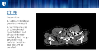 CT PE
Impression:
1. Extensive bilateral
pulmonary emboli.
2. Significant areas
of parenchymal
consolidation and
airspace disease
involving both lungs.
Small discrete
nodular densities
also present as
detailed.
 