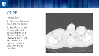 CT PE
Impression:
1. Extensive bilateral
pulmonary emboli.
2. Significant areas
of parenchymal
consolidation and
airspace disease
involving both lungs.
Small discrete
nodular densities
also present as
detailed.
 