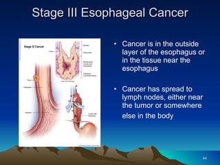 11 esophageal cancer