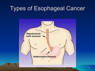 11 esophageal cancer