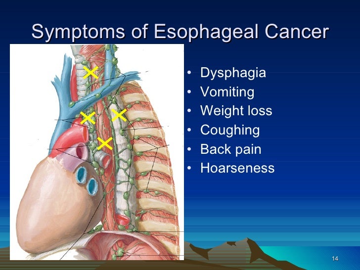 11 esophageal cancer