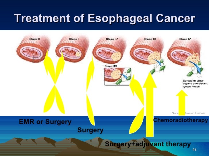 How is esophageal cancer treated?