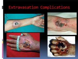 Extravasation Complications
 