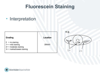 Fluorescein Staining
• Interpretation
Grading Location
0 = no staining
1+ = mild staining DRAW!
2+ = moderate staining
3+ = marked/severe staining
1+ 2+
e.g.
 